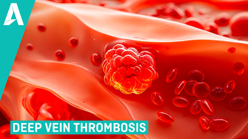 Deep Vein Thrombosis