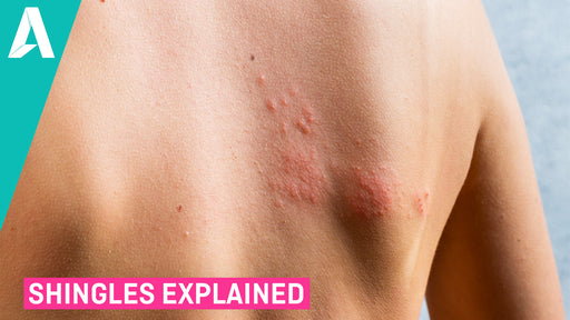 Shingles Explained